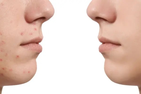 acne facial solutions