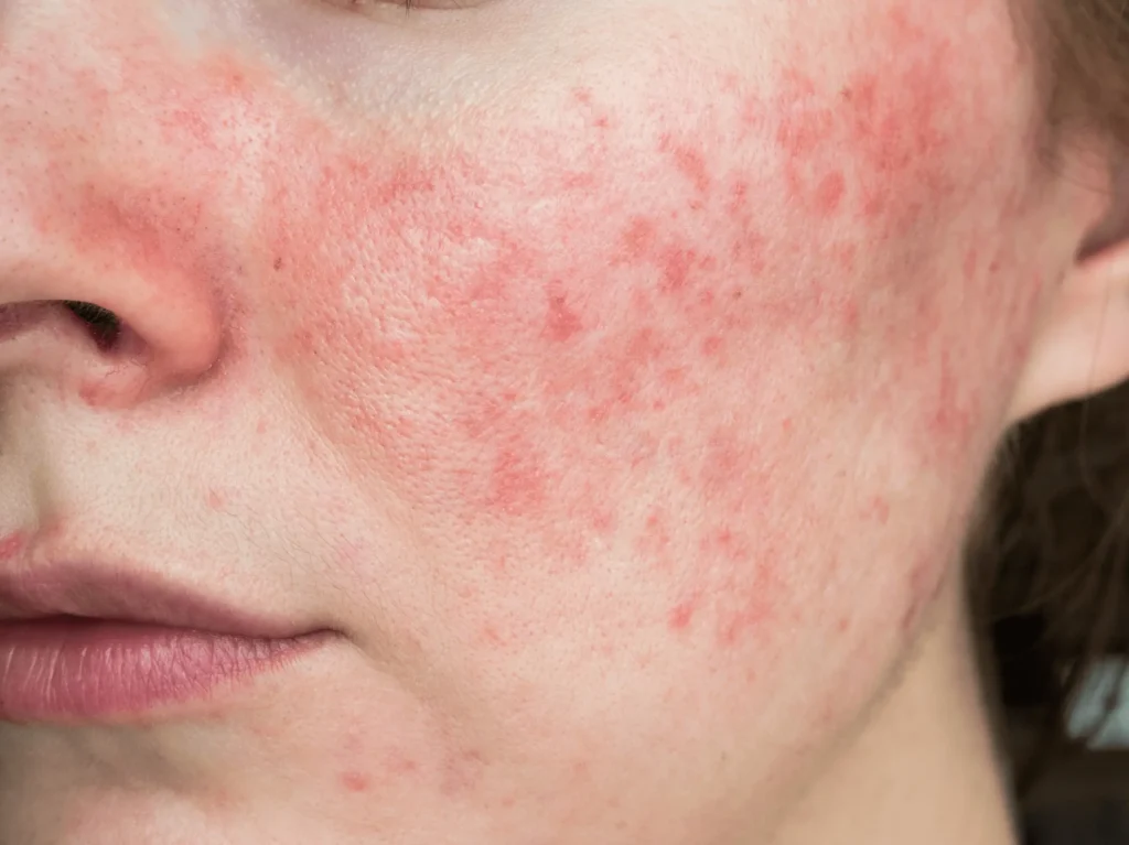 Rosacea Treatments