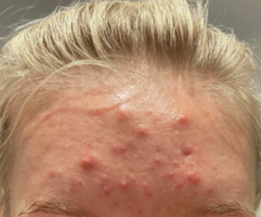 Acne And Blemishes on Forehead
