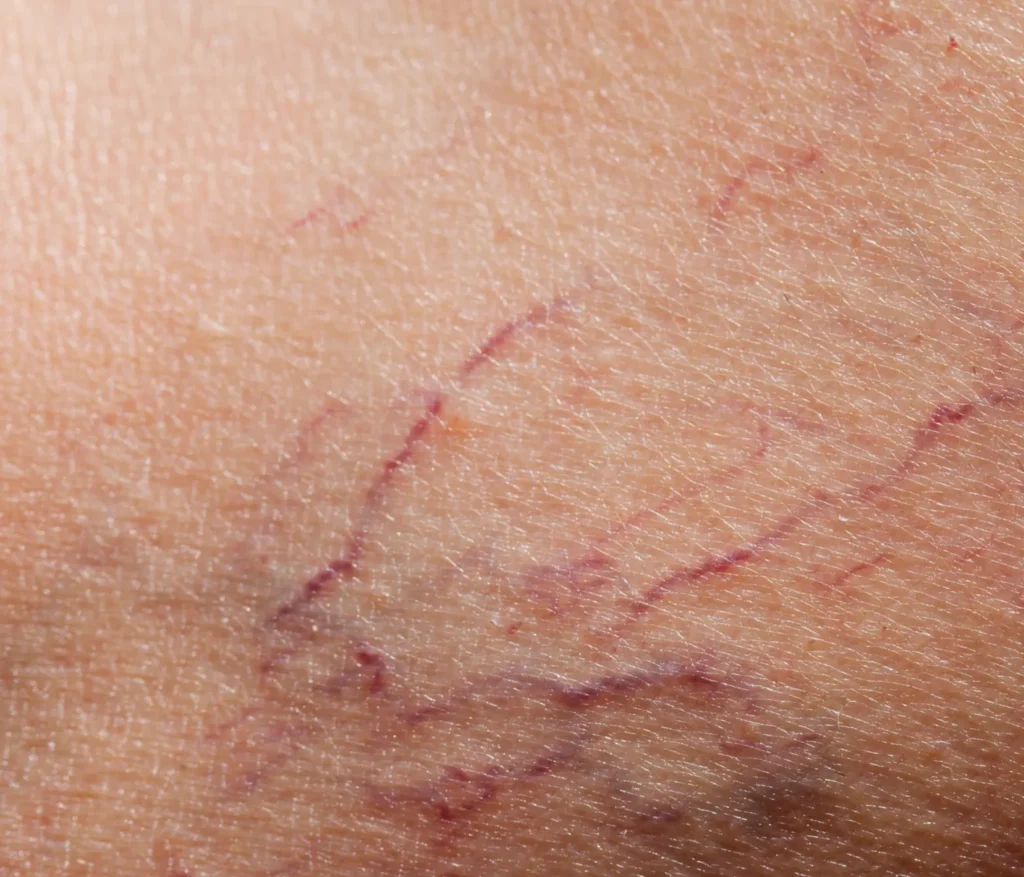 Spider Veins