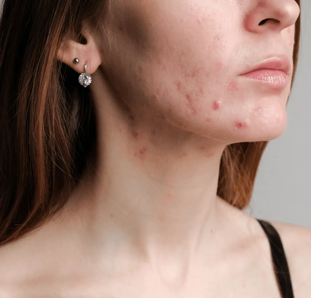 Acne Beaumont and Edmonton