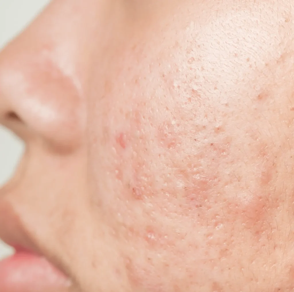 acne scars