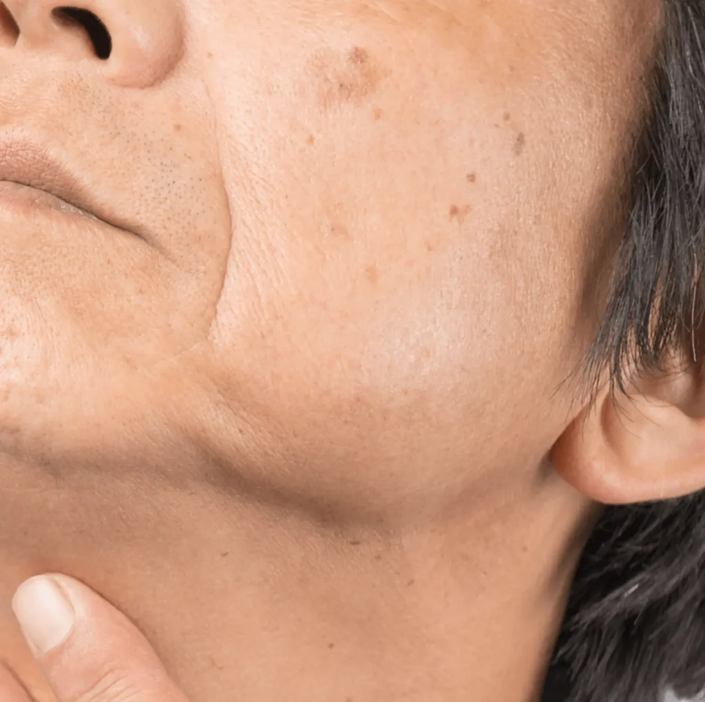 hyperpigmentation