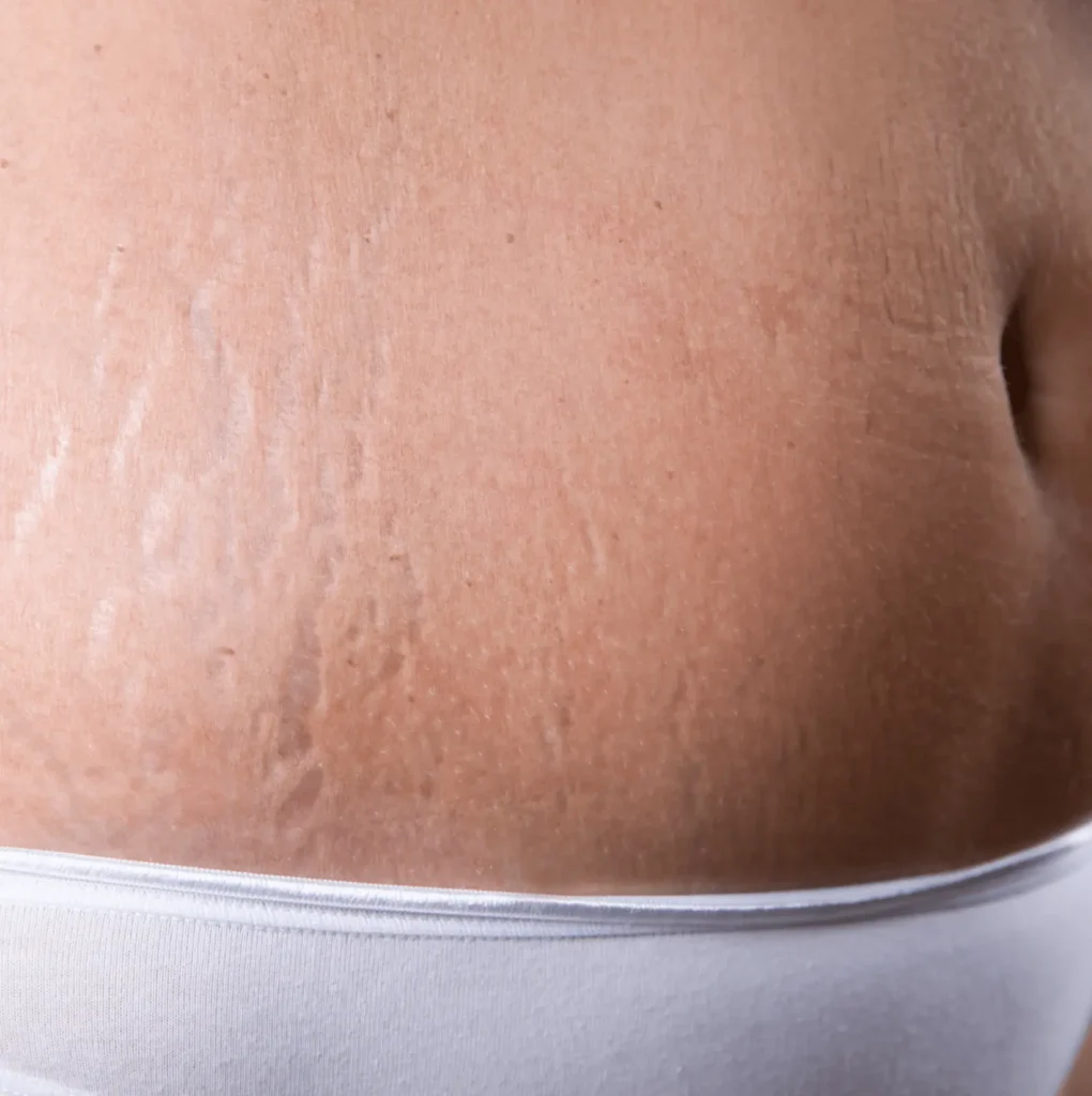 mummy tummy