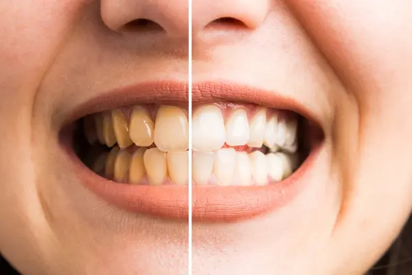 Teeth Whitening Services Beaumont MD SPA