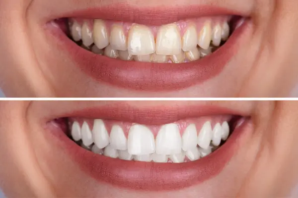 Teeth Whitening Services Beaumont MD SPA