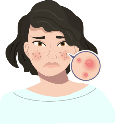 acne and blemishes