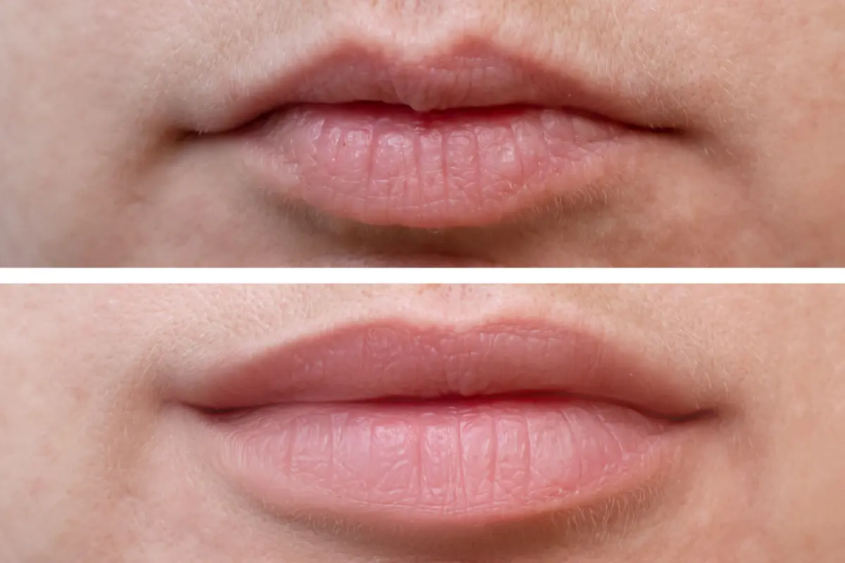 lip fillers before and after