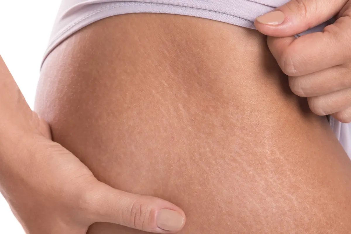 Laser Treatments - How To Get Rid Of Stretch Marks