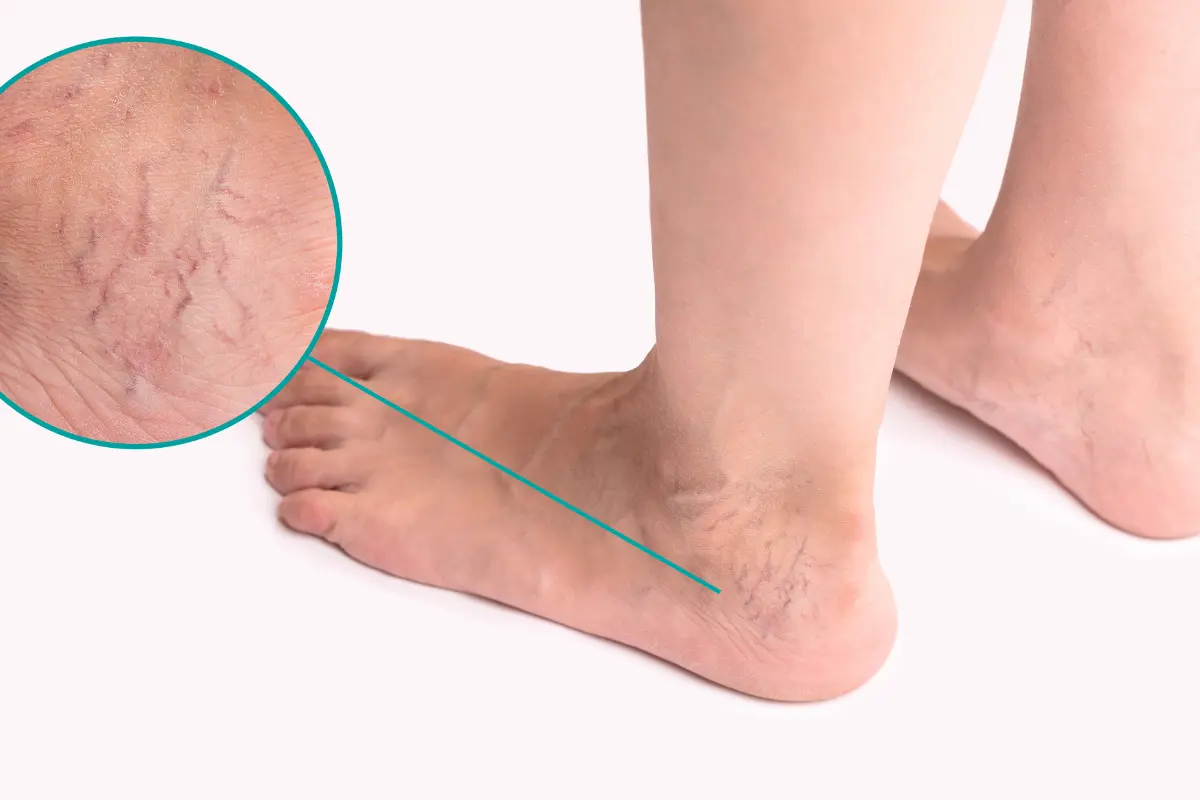 What Causes Spider Veins On The Ankles - MD SPA